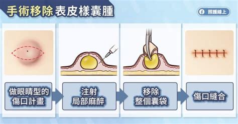 臉上有一顆凸起|表皮囊腫（粉瘤）：皮膚有凸起物分不清？不驚不怕！。